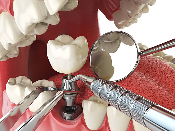 Best Emergency Root Canal Treatment in North Bend, WA